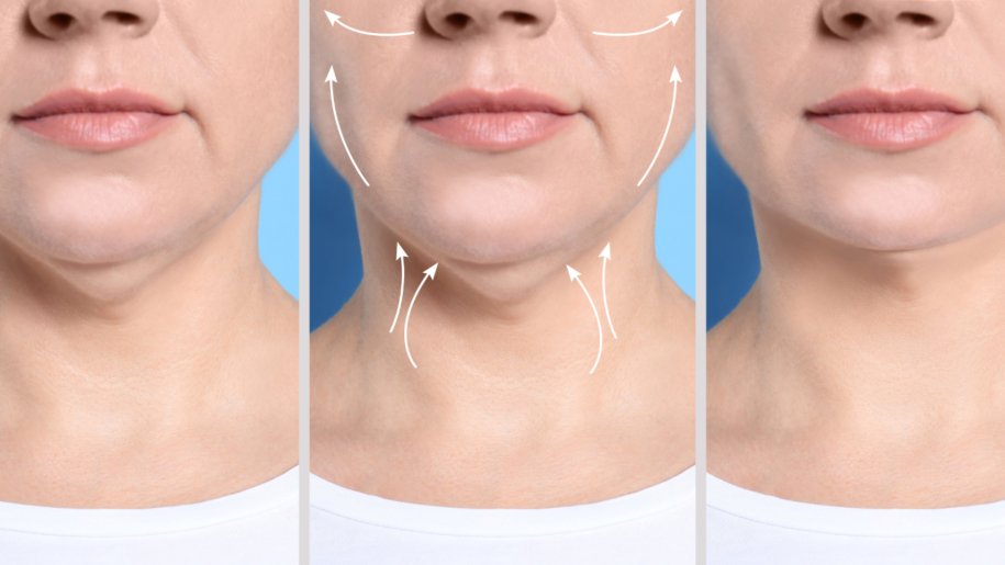 Chin Filler Bum Chin